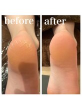 ビューシア(Beauxia)/足の角質ケア