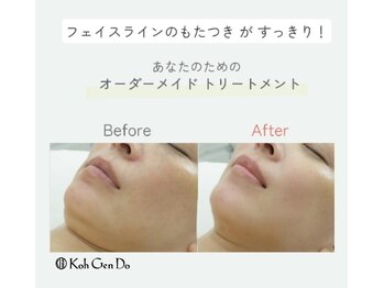 江原道 銀座サロン(Koh Gen Do)/フェイスラインの変化