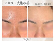 スリースリー 恵比寿(THREE THREE)/テカリ・脂性肌ケア