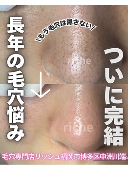 リッシュ RICHEの写真/どうにもならない頑固な毛穴に！毛穴の中に潜む詰まりをケアし、極上のマッサージがついてくる至福体験を♪