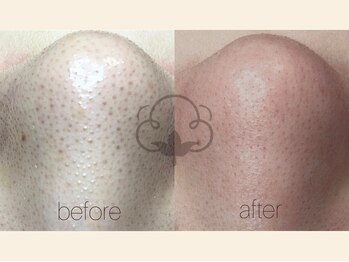 プライベートサロン コットン(COTTON)/毛穴エクストラクション