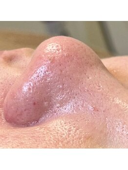 レプス(Lepus)/ハイドロ(+小鼻クレンジング)