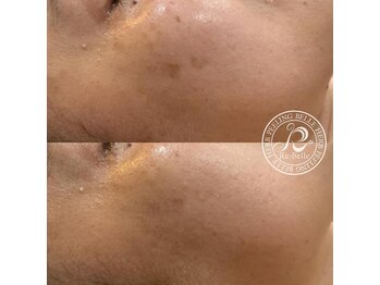 クリア 麻布十番(CLEAR)/OHLハーブピーリング　毛穴ケア