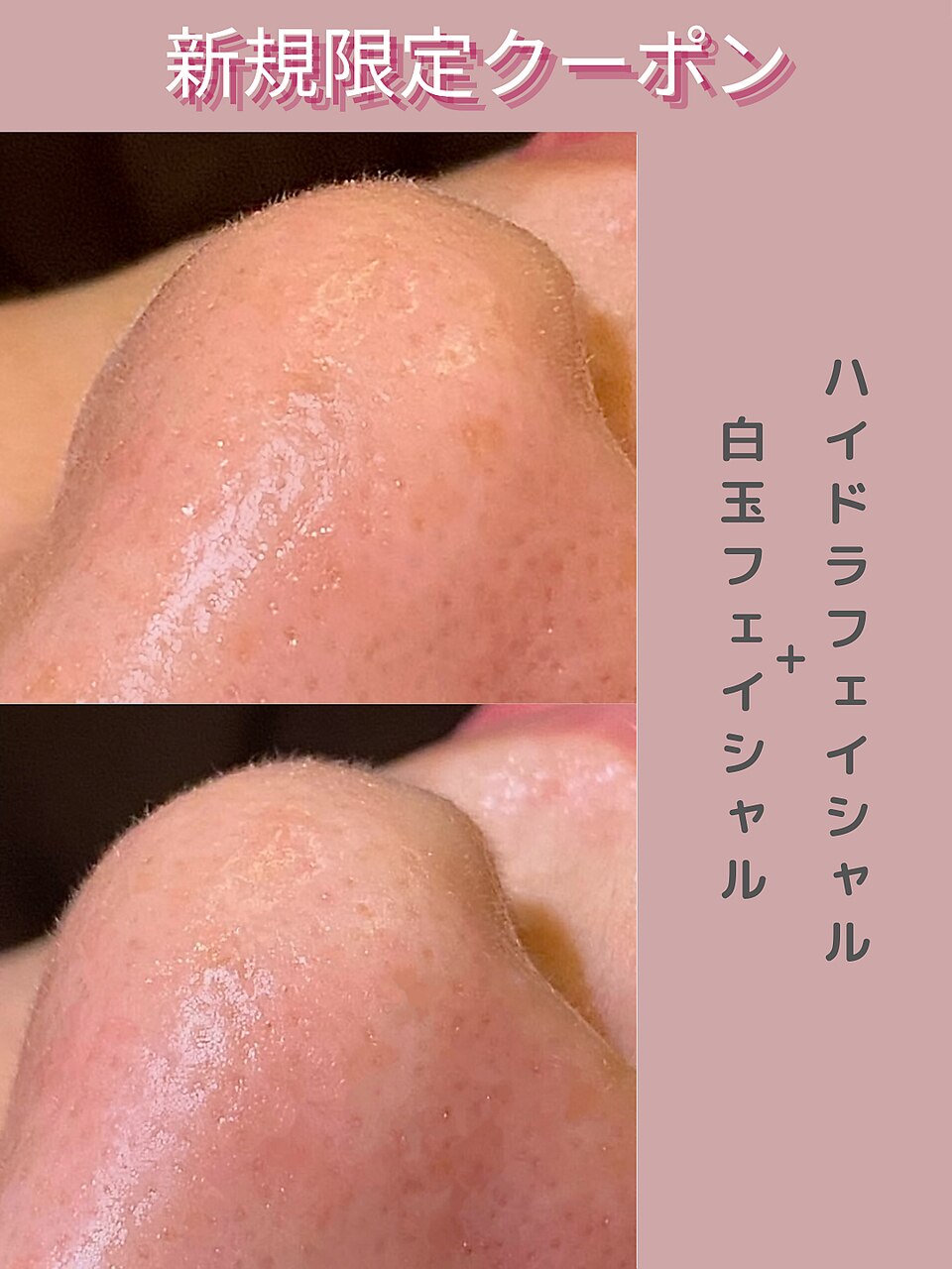 【毛穴洗浄/皮膚回復】ハイドラ＋白玉フェイシャル\11000
