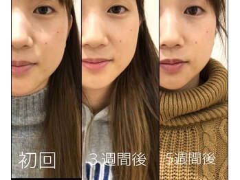 宇宿鍼灸整骨院/鍼灸【美容鍼】