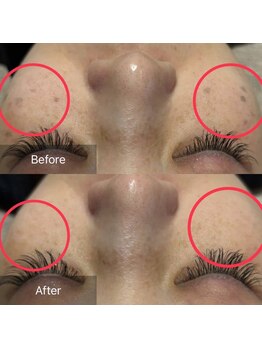 ハピエスト 御坊店/しみコース