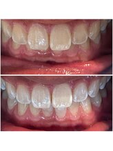 エクシアホワイトニング 代々木店/ホワイトニングビフォーアフター