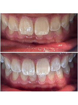 エクシアホワイトニング 代々木店/ホワイトニングビフォーアフター