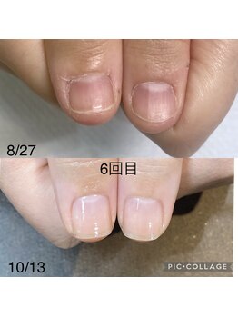 エル トウキョウ キャンディ(L tokyo CANDY)/爪育成ネイルケアの変化