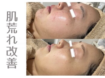 アニール(aniR)/ハーブピーリング/フェイシャル