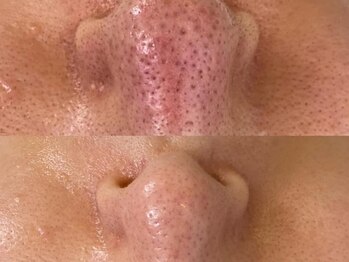 サロンドリー(salon de Re)/プロセルセラピーズ/肌質改善