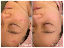 イリゼ(iriser)/プラズマフェイシャル