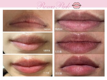 ビューティーリバース 新横浜店/ローマピンク_リップ施術例