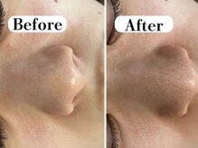 ビースキン 広島(BE:SKIN)/毛穴洗浄/ハーブピーリング