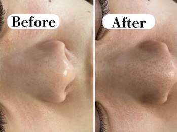 ビースキン 広島(BE:SKIN)/毛穴洗浄/ハーブピーリング