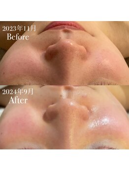 ボディヒーリングアンド小顔美容矯正 プララン/毛穴に特化メニュー☆