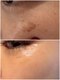 メディカルエース(MedicalAce)の写真/【最新フォト】全顔からポイントケアまでシミを集中ケア！ぼんやり広がる大人のシミや赤ら顔のお悩みにも◎