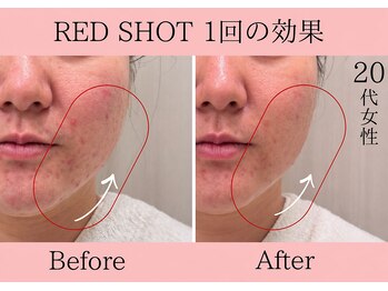 エトワール(etoile)/天王寺あべのRED SHOTで小顔