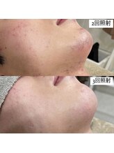 テンパ ビューティー(+10%beauty)/効果写真