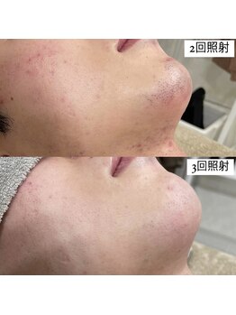 テンパ ビューティー(+10%beauty)/効果写真