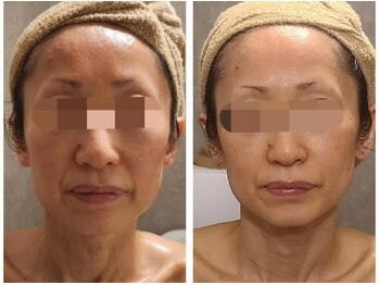 ウォーマル(warmaL)/小顔矯正/ほうれい線も薄く！