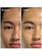 エース(ACE.)/ハーブピーリングの効果☆