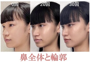 ラプリ 銀座店(Raplit)/隆鼻＋輪郭矯正40分30回