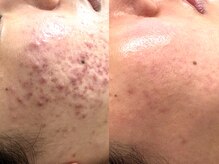 サロンドペオニー 川内店(salon de peony)の雰囲気（20代女性ニキビ改善[毛穴/小顔/フェイシャル］）