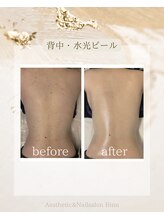 ビヌ(Binu)/背中水光ピール