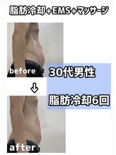 シャルム(CHARME)/脂肪冷却