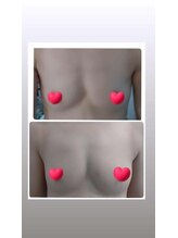 ソラ(SORA)/バストアップ症例