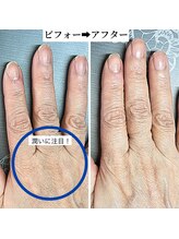 桃の木 吉祥寺店/自爪の変化はゆっくり