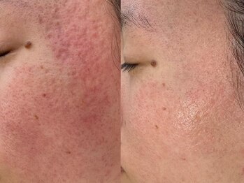 サロンドリー(salon de Re)/プロセルセラピーズ/肌質改善