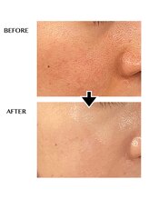 サロンドボーテ ノンノン(Salon de Beaute Non-non)/毛穴改善コース