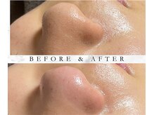 撫子アカデミー/毛穴洗浄＋ハーブ