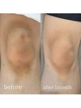 ラミパス(LAMIPAS)/ローマピンク症例　1ヶ月後