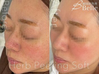 ベル 所沢(Belle)/ハーブピーリング｜ニキビケア