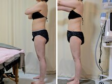 ひぺりかむ/【脂肪冷却】1週間「ステップ2」