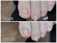 爪切り屋 足楽/【爪下血腫】爪が変形する