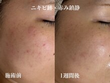 敏感肌の方にも優しい低刺激のピーリングを使用しております。