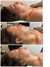 バックステージ鍼灸院(Backstage鍼灸院)/顎のケア