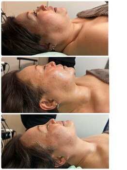 バックステージ鍼灸院(Backstage鍼灸院)/顎のケア