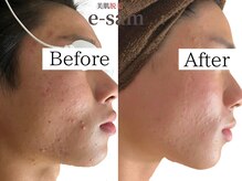 イーサム(e-sam)/光フェイシャル＆炭酸パック