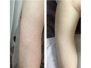 モカ 天王寺店(MOKA)/肌トラブル　毛穴ケア　ニキビ