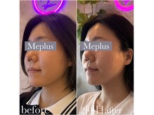 ミープラス(Me+)の雰囲気（希少マシンオンダマイクロ波リフト。脂肪燃焼＋タイトニング）