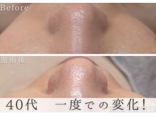 アルム(Areum)/ピーリングで毛穴の汚れ・縮小！