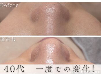 アルム(Areum)/ピーリングで毛穴の汚れ・縮小！