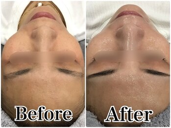 ルリアン(LeLien)/ダクトピール＋LDM 5回の効果！