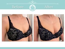 美人バスト 本厚木店/バストアップ◇症例◇