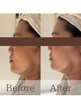 凪眠/小顔リンパフェイシャルの効果85